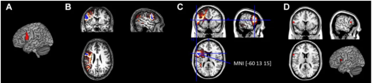 Fig. 1    An example of how the region of interest was computed for the  tractography and functional connectivity analysis