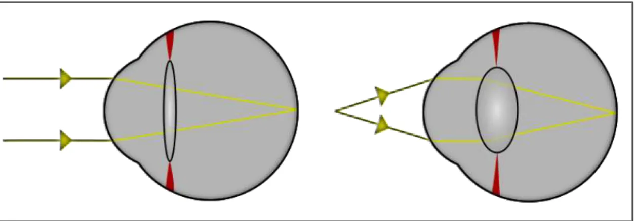 Gráfico 5 Ojo Présbita 