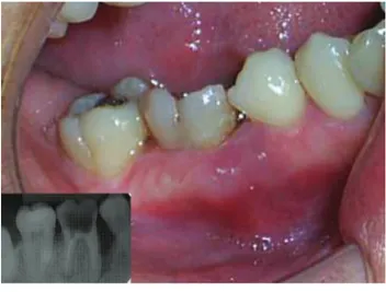Figura 2. Absceso periodontal a nivel de la pza. 4,6