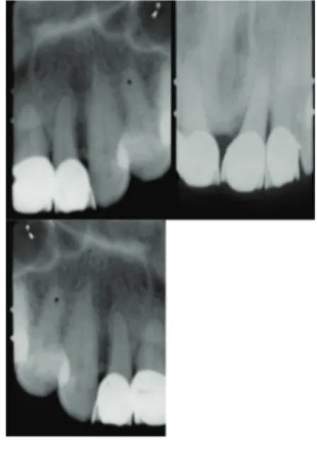 Fig. 4 Radiografías periapicales preoperatorias del  paciente anterior, nótese la radiolucidez mesial y 