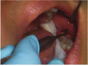 Figura 8. Desbridamiento y raspado profundo de un  absceso pericoronario.