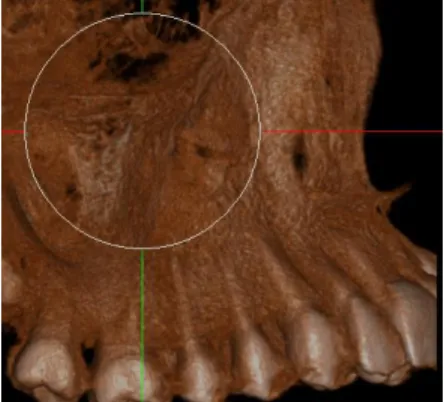 Figura 6. Espacio Interdental
