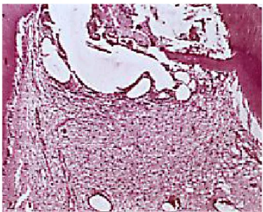 Figura 1.2. Calcificación pulpar. 