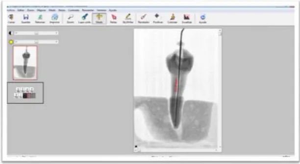 Figura 10 Aplicación de la herramienta positivar y luego medir (radiografía digital invertida) 