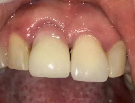 Ilustración 11. Cicatrización del tejido periodontal en OD 11 luego de 45 días del alargamiento coronal, con  restauración definitiva.