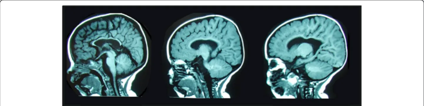 Fig. 3 Magnetic resonance imaging of the brain evidencing corpus callosum hypoplasia