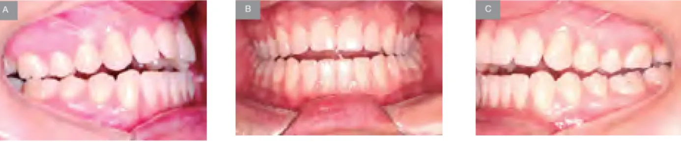 Figura 1. Note la mordida abierta que la paciente poseía antes del tratamiento, abarcando también los dientes posteriores