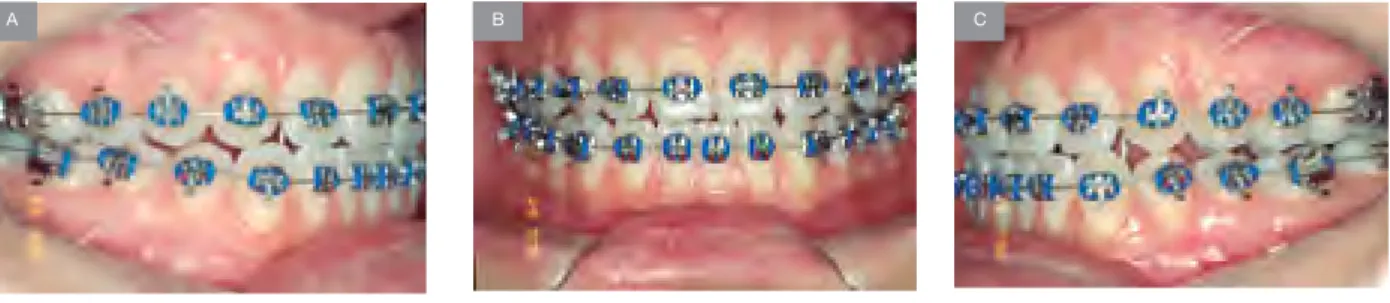 Figura 3. Fase inicial del nivelamiento y alineamiento dentario. Desde los estadios iniciales es importante retirar  los contactos prematuros que pueden mantener al individuo en mordida abierta