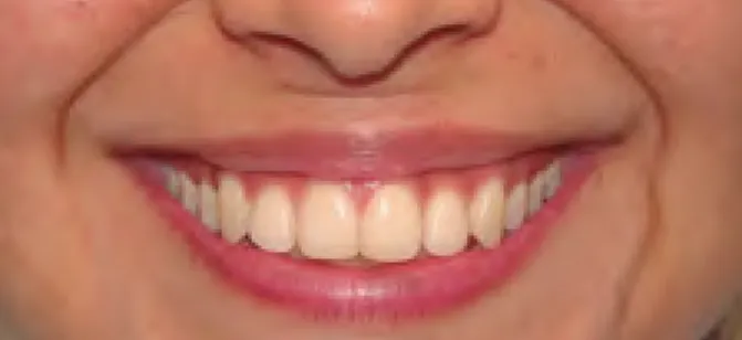 Figura 1. Sonrisa agradable donde se muestra alineación de  dientes anterosuperior
