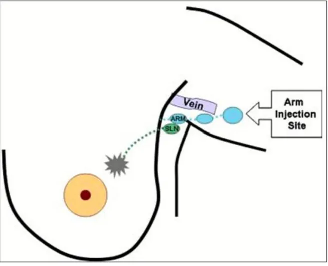 Figura  1.  Esquema  que  grafica  el  concepto  de  Mapeo  Axilar  Reverso  (MAR)  (Fuente:  University  of  Arkansas  for  Medical  Sciences