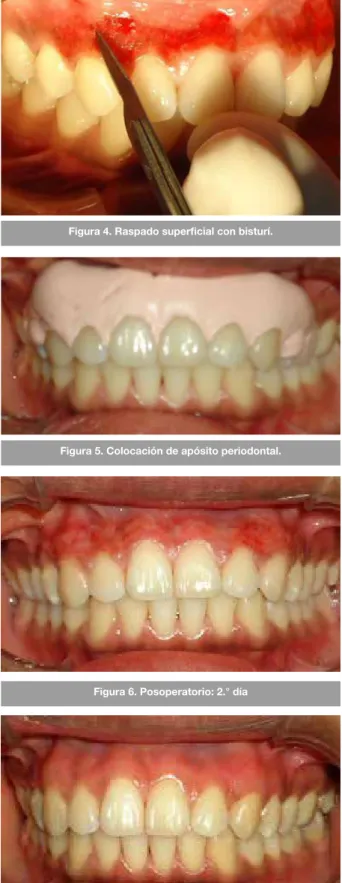 Figura 5. Colocación de apósito periodontal.