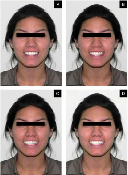 Figura 1. Fotos de mujer. A: sin desviación. B: desviación de 1 mm, C: desviación  de 3 mm, D: desviación de 2 mm