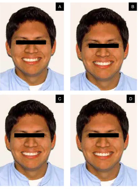 Figura 2. Fotos de hombre. A: desviación 3 mm. B: sin desviación. C: desviación de  2 mm