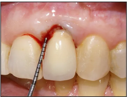 Figura 2: Presencia de mucositis periimplantar en restauración unitaria  implanto-soportada en sitio de pieza 2.2 