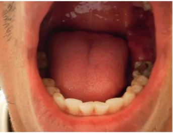 Figura 3. Tumoración a nivel de la primera molar inferior izquierda