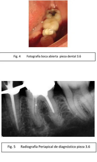 Fig. 4  Fotografía boca abierta  pieza dental 3.6 