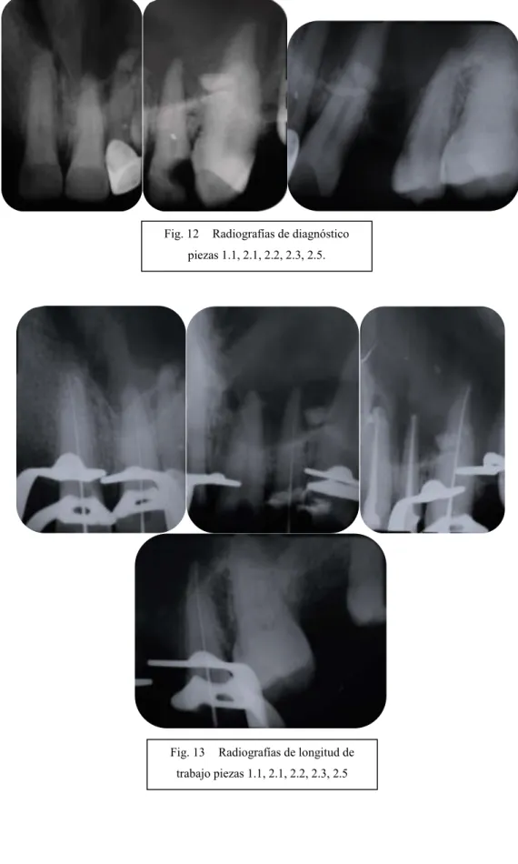 Fig. 12  Radiografías de diagnóstico  piezas 1.1, 2.1, 2.2, 2.3, 2.5. 