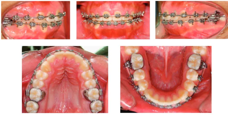 Fig 6. Fotografías intraorales de avance.