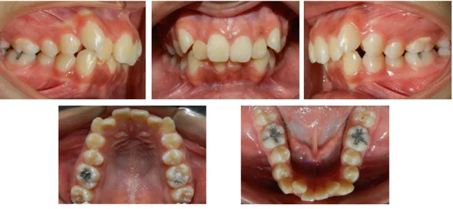 Fig. 8 fotografias intraorales muestran la discrepancia dentaria severa  superior e inferior