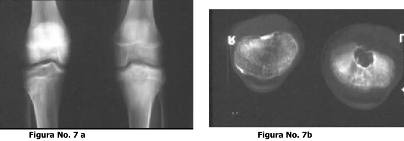 Figura No. 6a Encondromatosis múltiples en tibia Izquierda, lesión central de bordes  esclerosos Localizadas distalmente