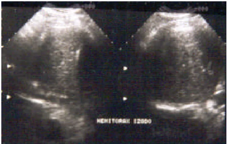 Figura 2:  Ultrasonido torácico. Imagen de consolidación  parenquimatosa (pulmón hepatizado) 