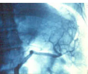Figura 6:  Aortograma en donde se observan ramas de la arteria  esplenica que se dirigen hacia el pulmón