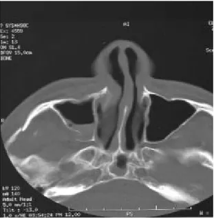 Figura 1:  Corte axial de tomografía computarizada. Fractura de la  pared posterior del seno maxilar derecho