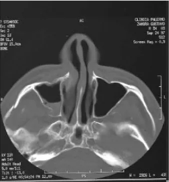 Figura 5:  Imagen de tomografía computarizada con ventana  para hueso. Fractura del arco cigomático derecho, Fractura  del maxilar derecho asociada