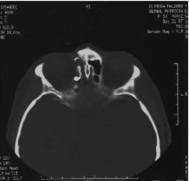 Figura 7:  Imagen  de tomografía computarizada con ventana  ósea. Fractura deprimida de la lámina papirácea del etmoides  en el lado derecho