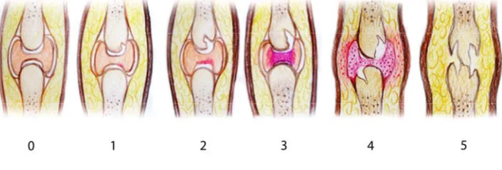 Figura 1. Clasificación de erosiones por método de Sharp van der Heijde  puntaje para erosiones