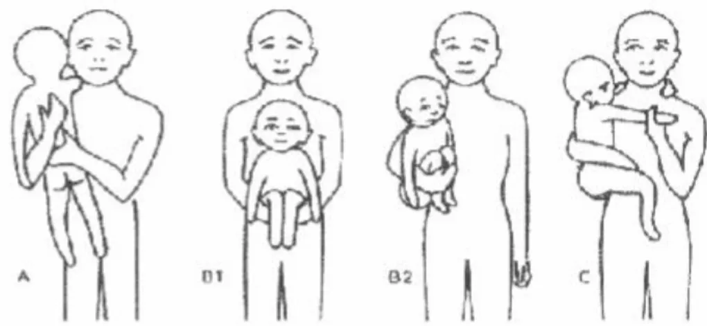Figura 4: Métodos para transportar al niño con CP   Tomado de Neurología para fisioterapeutas [22] 
