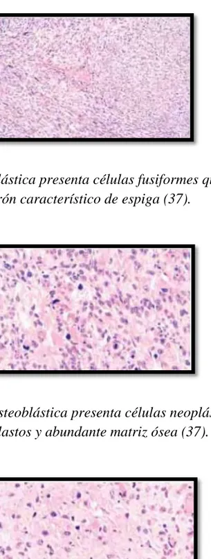 FIGURA 3. Variante Condroblástica presenta células cartilaginosas malignas son  predominantes (37)