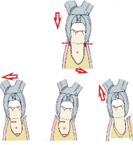 Fig 1. Movimientos a realizar en extracciones de molares superiores permanentes. 2 