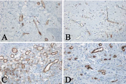 Table 1. Comparison of the extent and intensity of EGFR expression in normal oral mucosa,  oral epithelial dysplasia and oral squamous cell carcinoma.