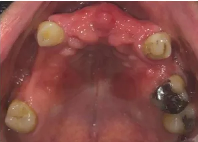Figura 1: Estomatitis subprotésica tipo I 