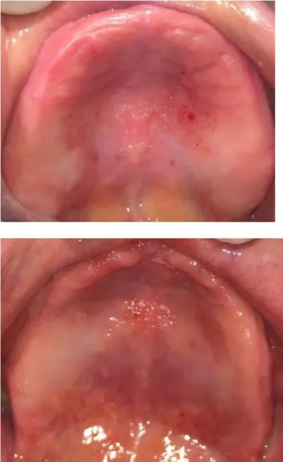 Figura 2: Estomatitis subprotésica tipo II 