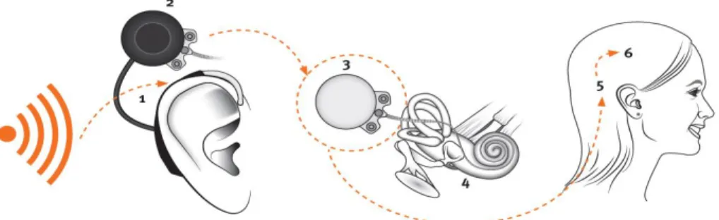 Figura 3. Funcionamiento del implante coclear 