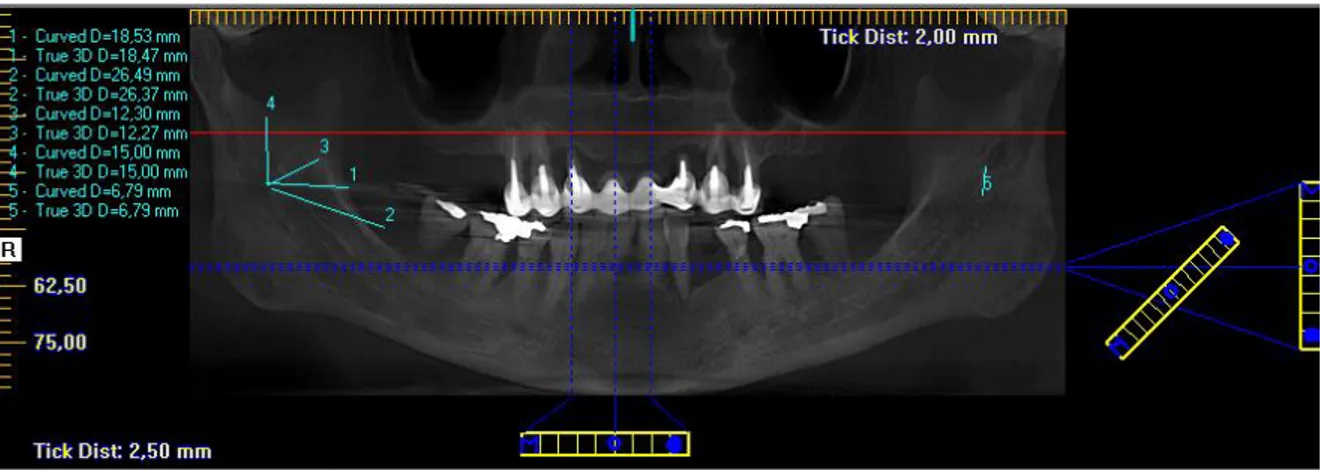 Fig III: 1 distancia del foramen mandibular al borde anterior, 2 distancia del foramen mandibular al trígono retromolar,  3  distancia  del  foramen  mandibular  a  la  cresta  temporal,  4  distancia  del  foramen  mandibular  a  la  escotadura  semilunar