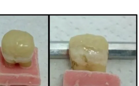 Figura N°5. Forma cilíndrica del material restaurador adherido al diente. La restauración  tiene 4 mm de alto y el ancho corresponde al perímetro de cada diente