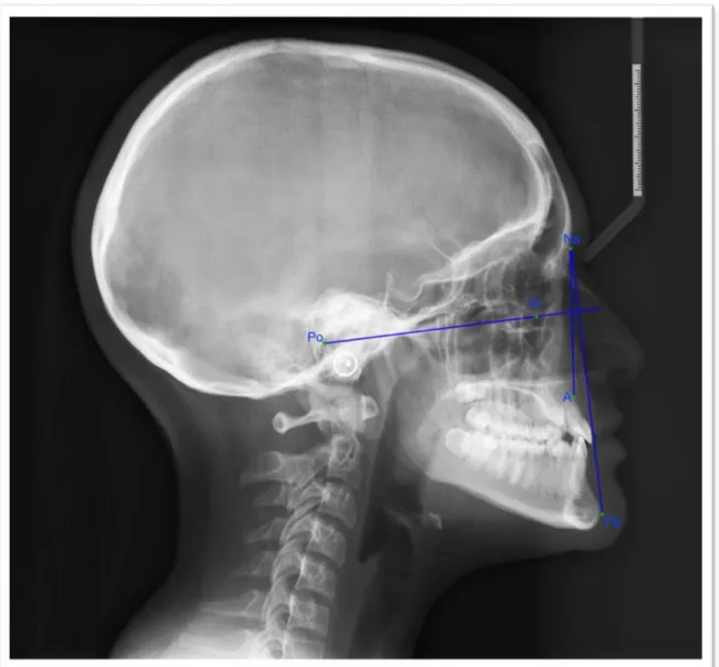 Figura Nº4: Trazado cefalometría de Ricketts 