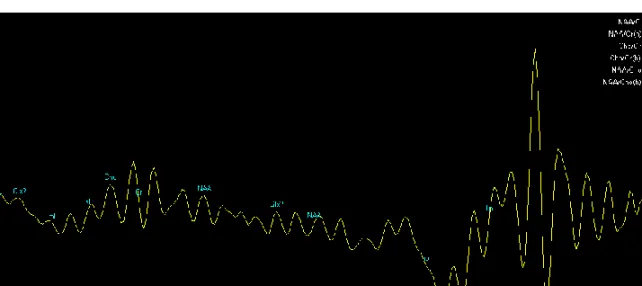 FIGURA 6.2: Gráfico correspondiente a H-ERM clínico. Muestra 50 ml  de etanol a  99 % de concentración