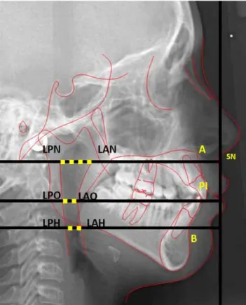 Fig. 1. Cephalometric tracing for anteroposterior distance of the upper airway. The Nasopharynx  is constructed by a perpendicular to a true vertical line passing through Subnasale (point where the nasal septum and the upper lip meet in the midsagittal pla