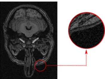 Figure 1.1: Magnetic Resonance Image (left). Close up at pixel level (right)