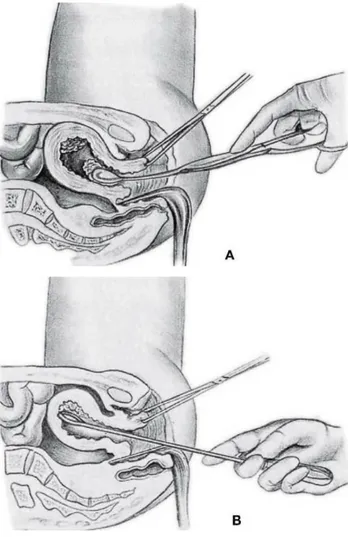 Figura 12: Legrado uterino. Una vez explorada la paciente para constatar la estática del útero y su  tamaño, se hace tracción del labio anterior del cuello y se realiza la histerometría