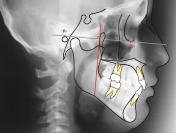 Fig. 05.- Plano vertical pterigoide