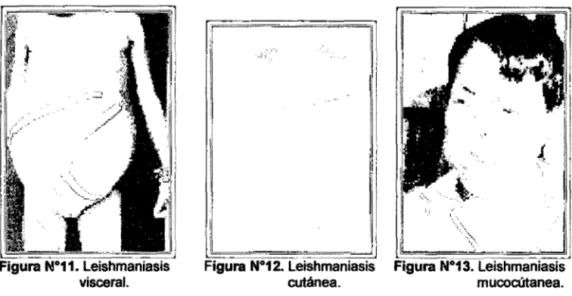 Figura N°12. Leishmaniasis 