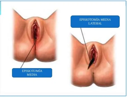 Fig. 01: Tipos de episiotomía 