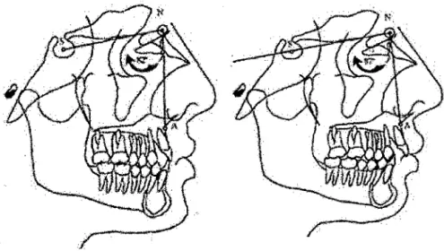 FIG.  N° 3 . Ángulo SNA.FIG. N° 4,  Ángulo SNA aumentado. 