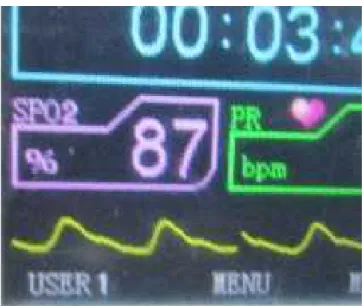 Fig. 3. Pantalla  del  monitor  mostrando  el  valor  mínimo (87%)  de  saturación  de  la  hemoglobina  por  el oxígeno, en la ciudad de Cajamarca.