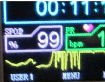 Fig. 5. Pantalla  del  monitor  mostrando  el  valor  máximo (99%)  de  saturación  de  la  hemoglobina  por  el oxígeno en la ciudad de Cajamarca.